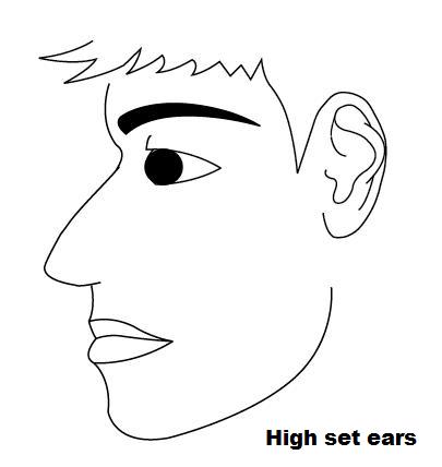high set ears